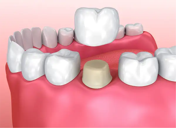 Dental Crowns & Bridges