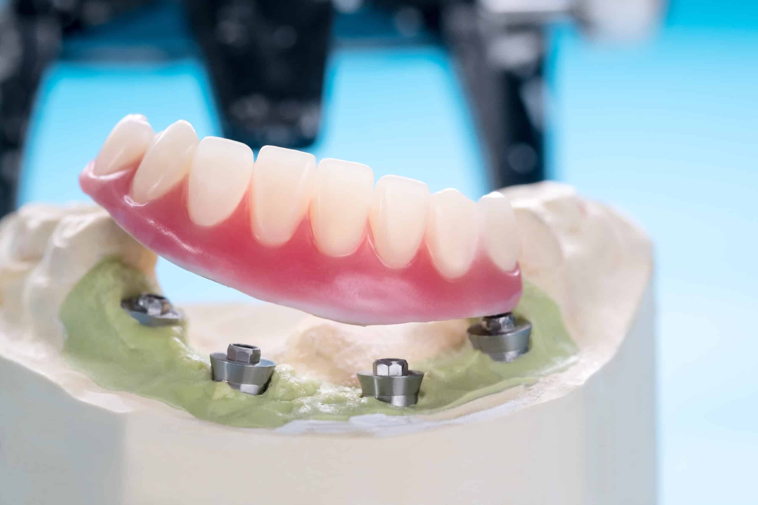 Closeup/ Dental implants supported overdenture on blue background/ Screw retained/ implant restorations
