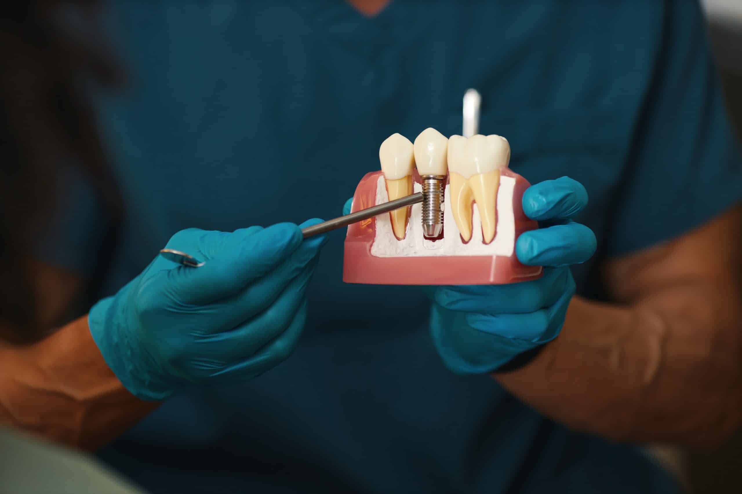 mini-dental implants in Fresno
