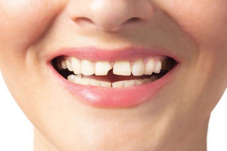closeup of a woman with a chip in her front tooth